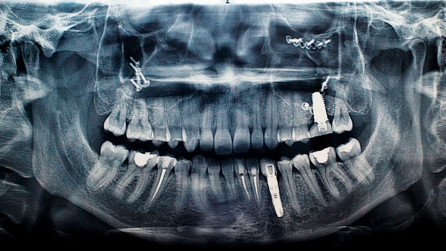An X-ray showing a patient with dental implants. (Getty Images)